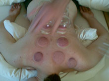 Chinese Cupping